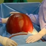Tenkodogo : une patiente soulagée d’un kyste de 20kg