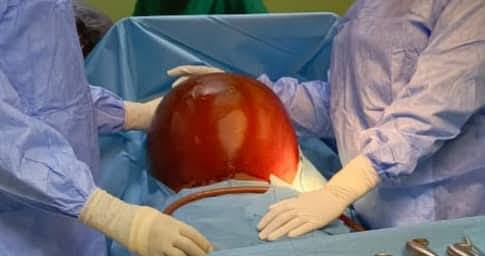 Tenkodogo : une patiente soulagée d’un kyste de 20kg
